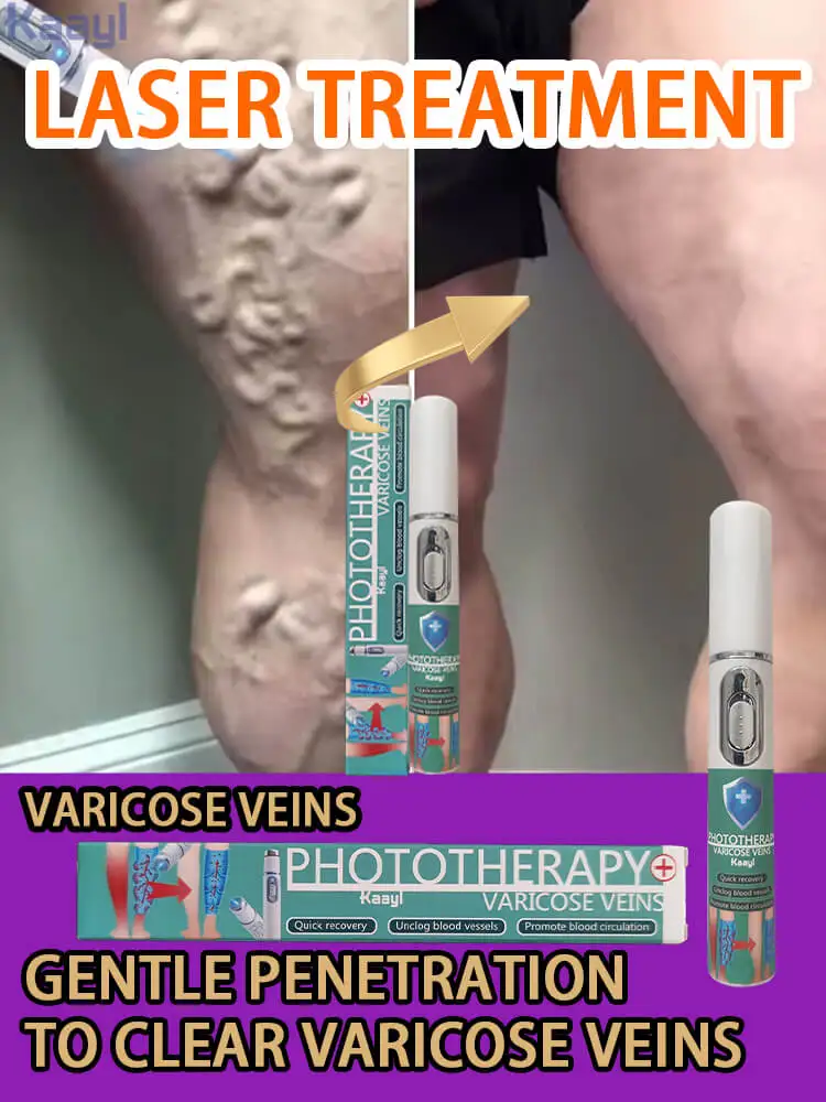 

Improves Blood Circulation | Reduces Spider Veins and Heaviness | Varicose vein laser pointer