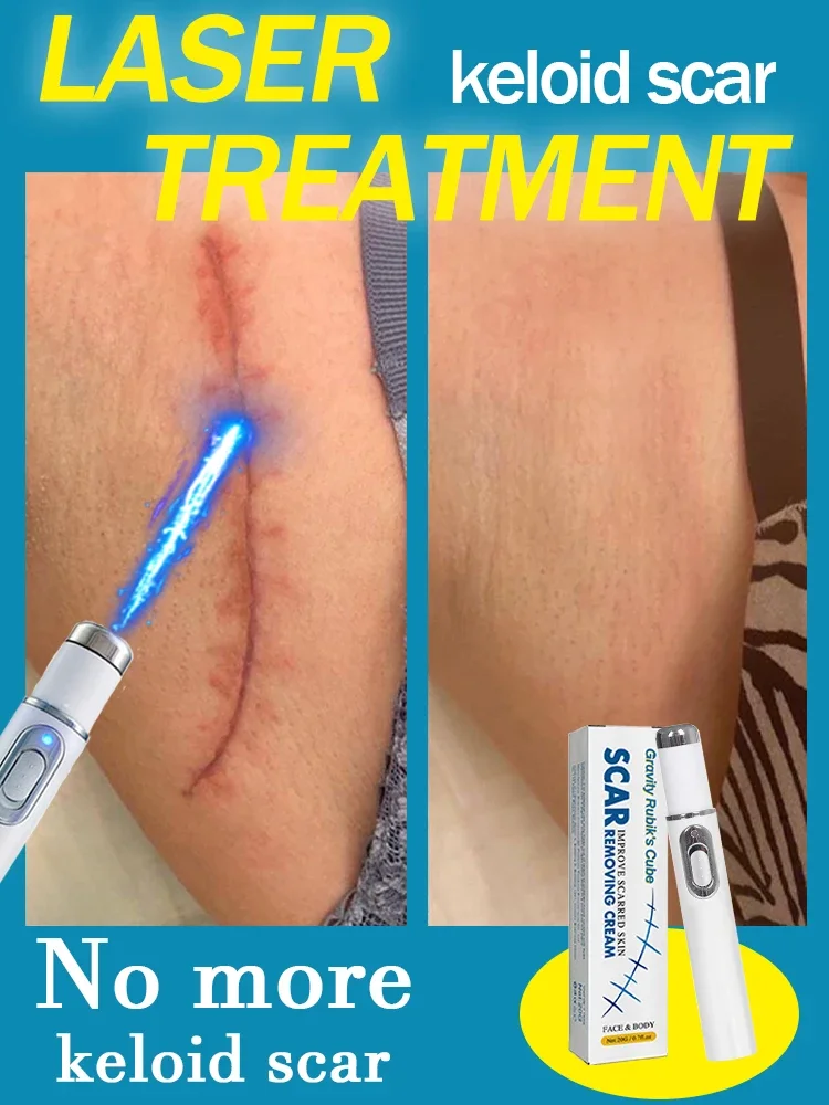 Riparazione cheloide Laser altamente efficace