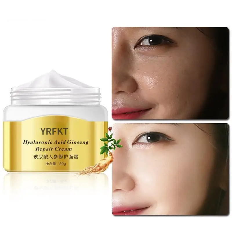 Hyaluronic acid ginseng acne removing cream acne removing printing face cream acne removing facial oil control skin care