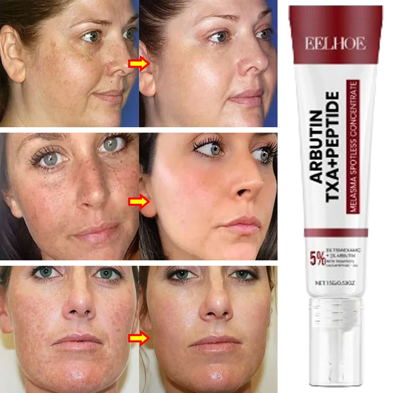 Poderosa creme de clareamento para remoção de manchas, ilumina a pele, elimina rapidamente a pigmentação da melanina, melasma, manchas escuras, cuidados com a pele coreanos