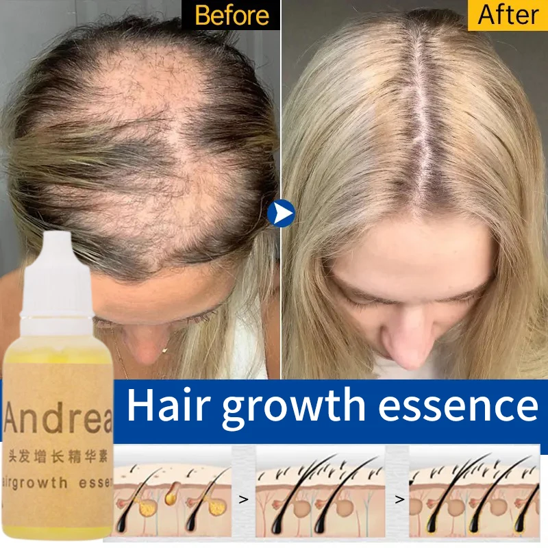 3/5 قطعة أندريا زيت نمو الشعر جوهر سماكة لنمو الشعر مصل تساقط الشعر المنتج 100% مستخلص نباتي طبيعي سائل 20 مللي #5