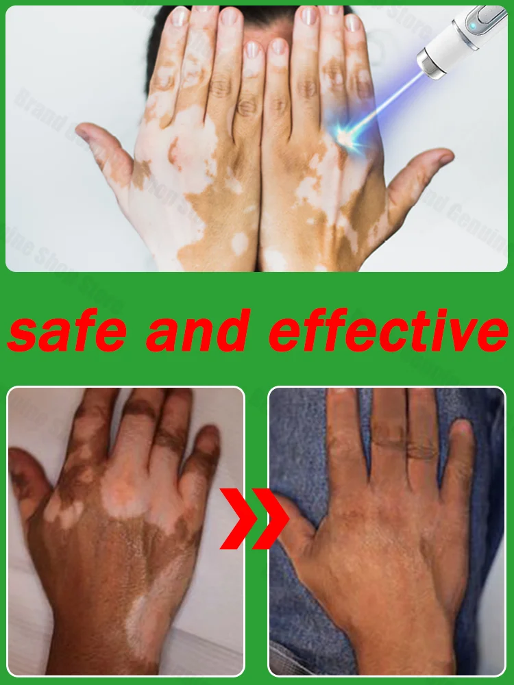 White spots vitiligo  Disappear