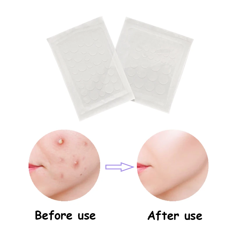 

48/72 pcs Acne Pimple Patch Sticker Acne Treatment Pimple Remover Tool Blemish Spot Facial Mask Skin Care маска для лица