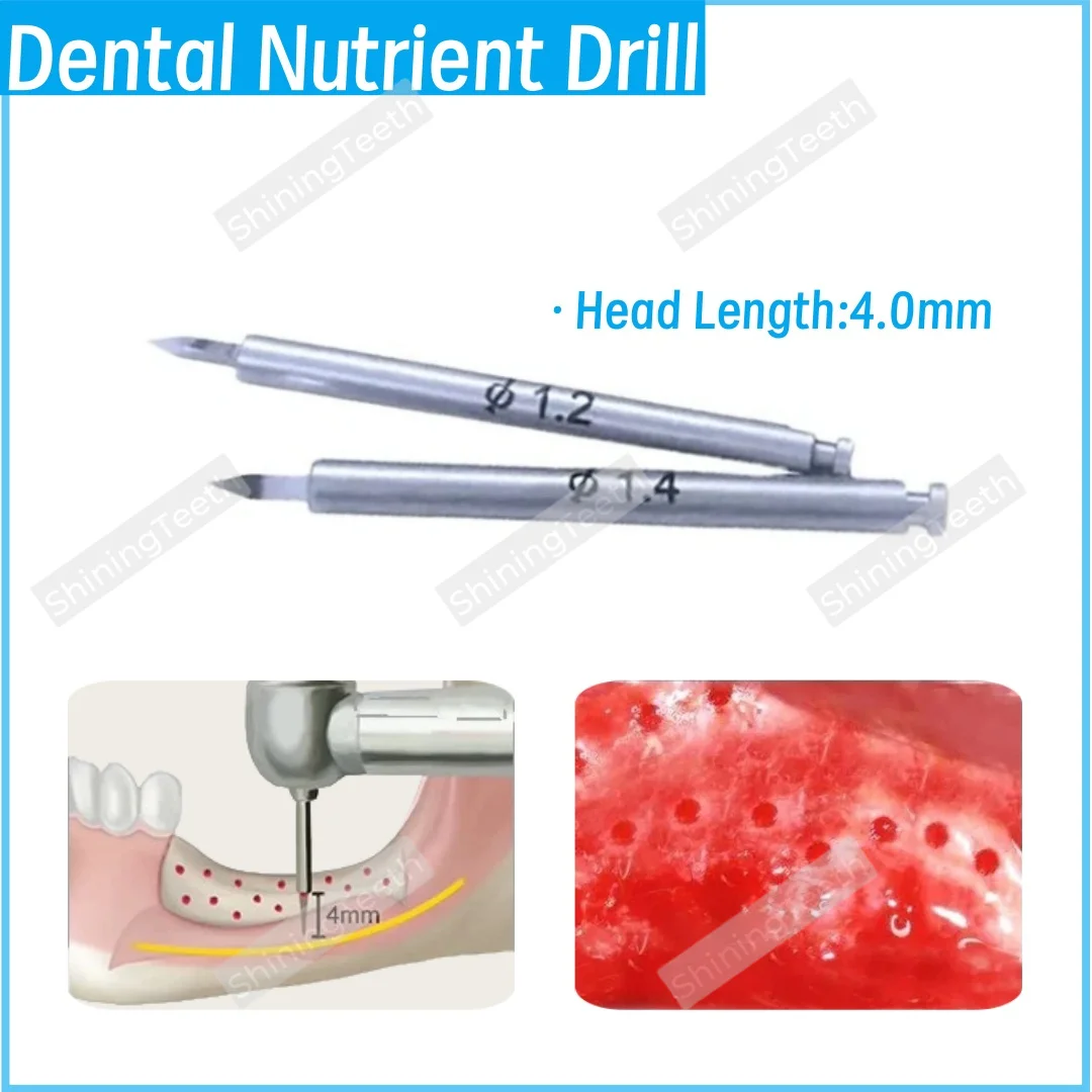 

Стоматологическое питательное сверло GBR Promotes New Bone Formation для имплантатов Bone Increment ∅1,2 мм/1,4 мм