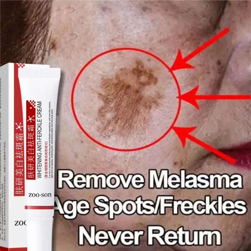 

Powerful Spot-removing Whiten Cream Brighten Skin Fast Eliminates Melanin Pigmentation Melasma Dark Spots Korean Skin Care