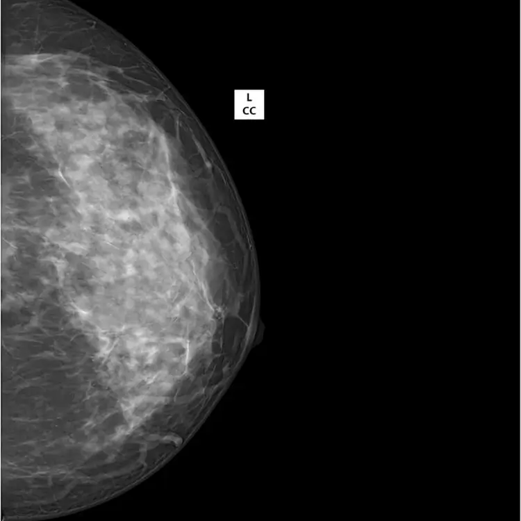 Amorphous Silicon Cesium Iodide (CsI) Mammography Detector Flat Panel Detector 10\