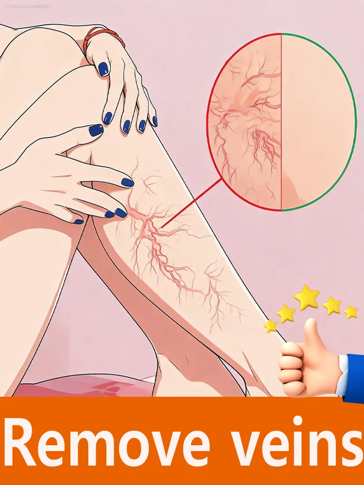 Rᴇᴍᴏᴠᴇ ᴠᴀʀɪᴄᴏsᴇ ᴠᴇɪɴs,Mild Care for Limbs, No More Odd Discomfort，2026 new products