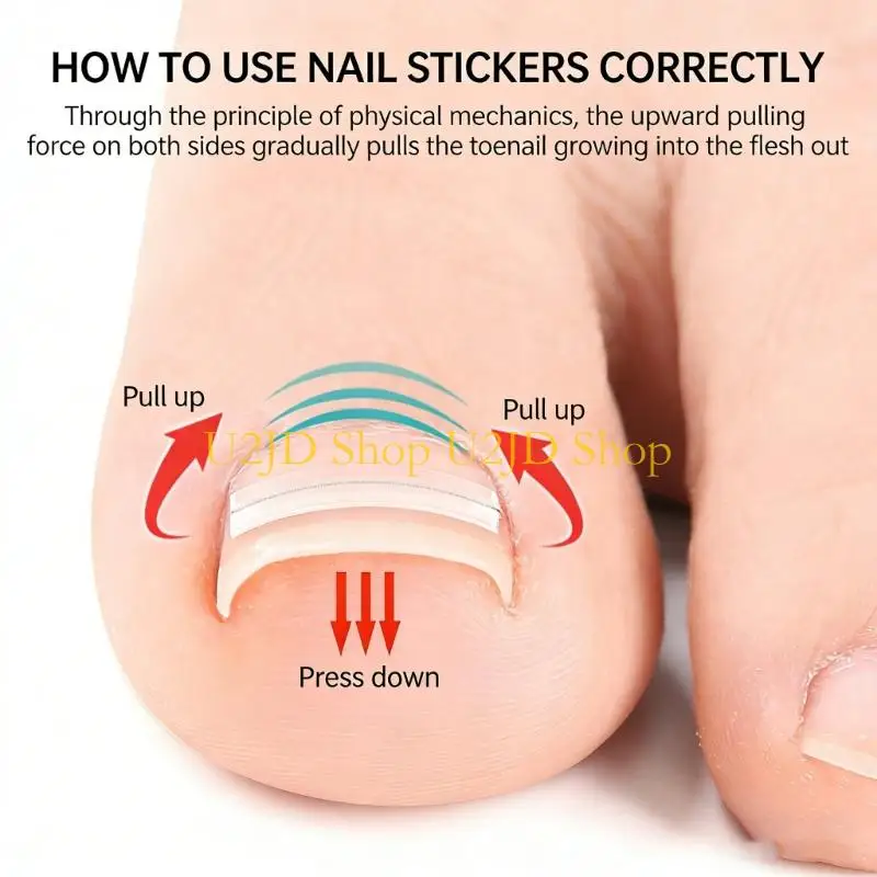 U2JD Soft TPE Ingrown Correctors With Gentle Pressure For Easy Application