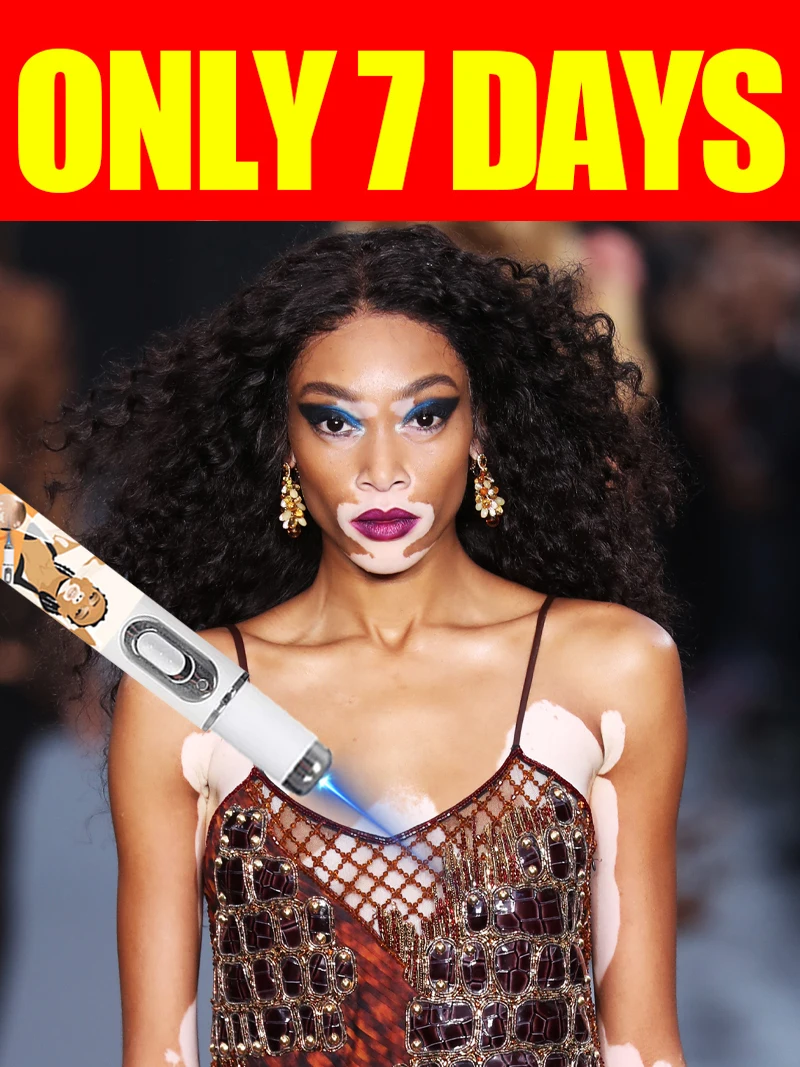 

Generation-2 Laser Says Goodbye To Vitiligo In 7 Days