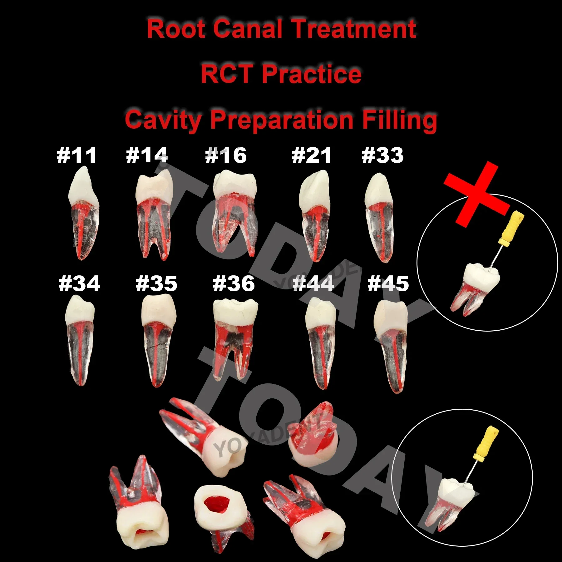 Dental Endo Root Canal Treatment Study RCT Practice Model Kilgore Nissin Type For Cavity Preparation Filling Practice Teaching