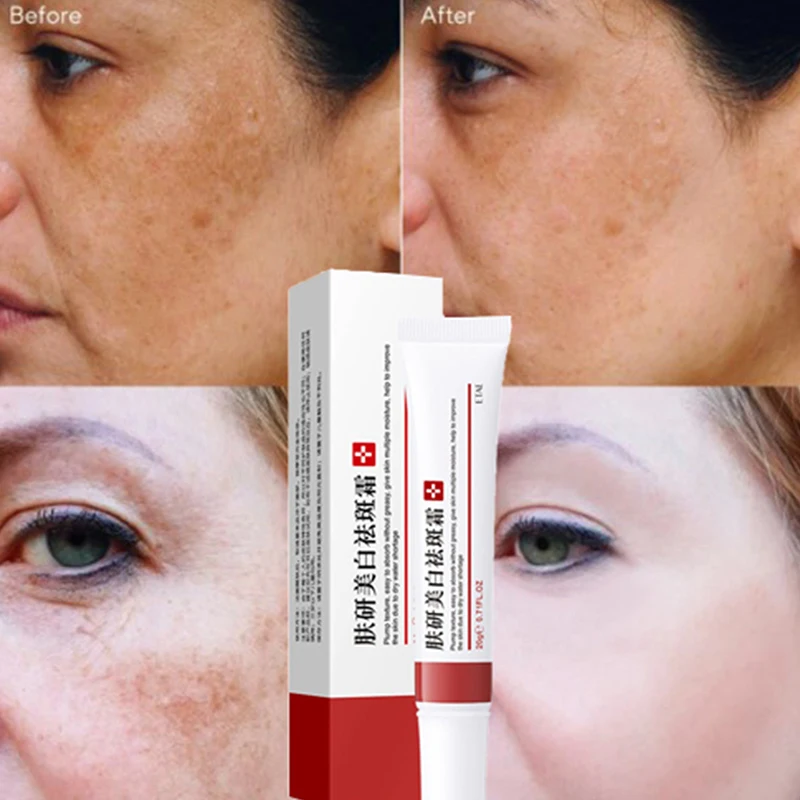 1PCS 20ml Whitening Freckle Cream Remove Melasma Acne Spot Pigment Melanin Face Cream