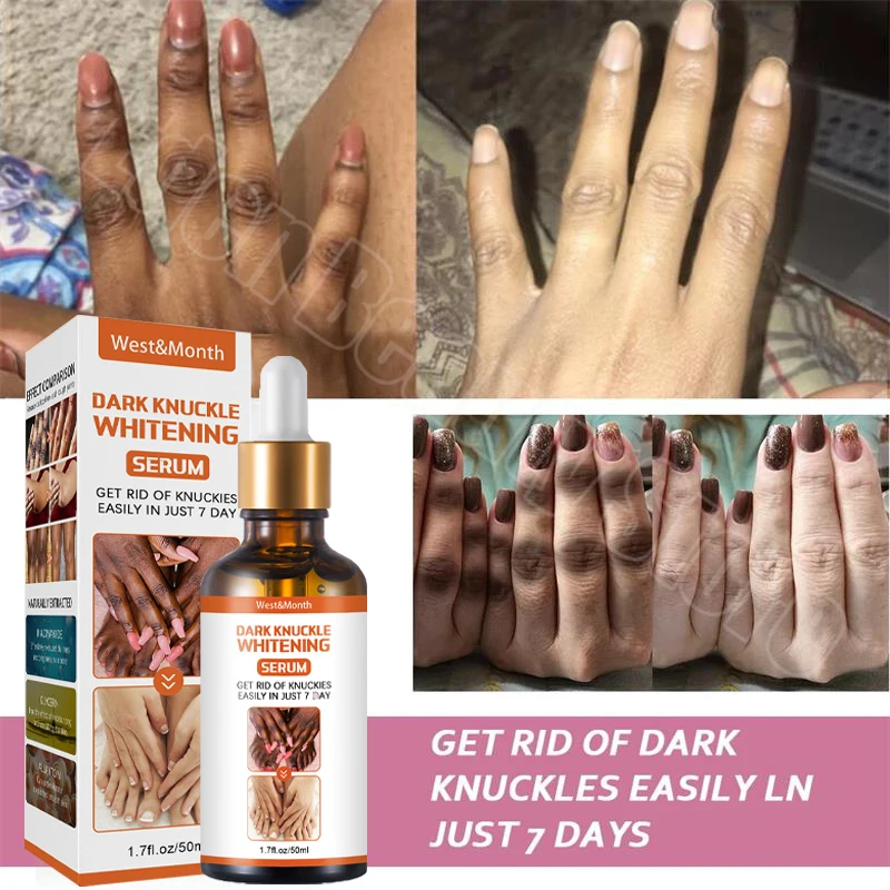 Dark Knuckles Fast Whitening Serum Intense Stains Remover Hand Knuckle Elbows Knee Melanin Corrector  Products Beauty Care 50ml