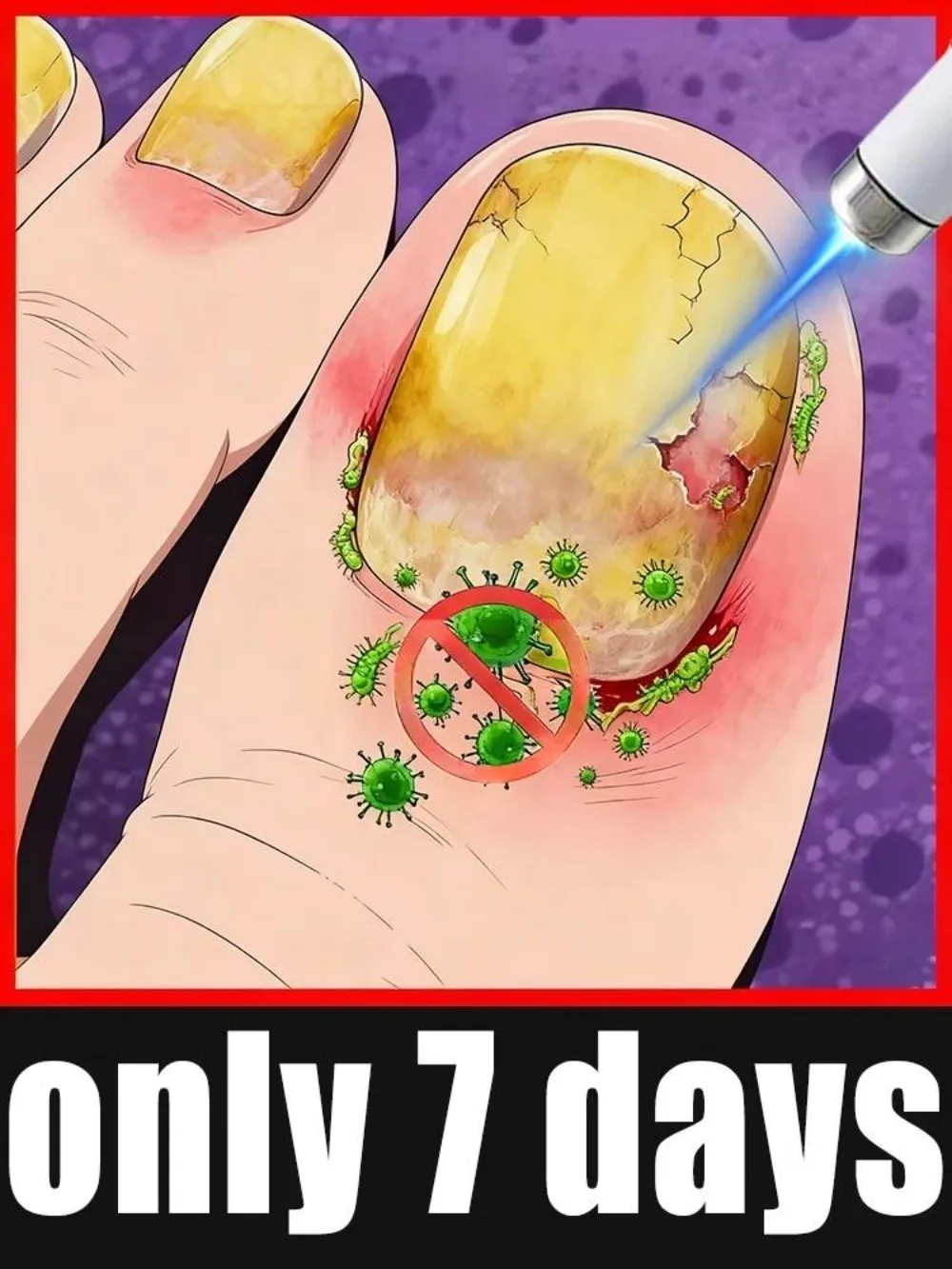 

The fifth generation-nail laser pen helps remove nail fungus,colorless and long-lasting sterilization,Tᴇᴄʜɴᴏʟᴏɢʏ ᴄʜᴀɴɢᴇs ʏᴏᴜʀ