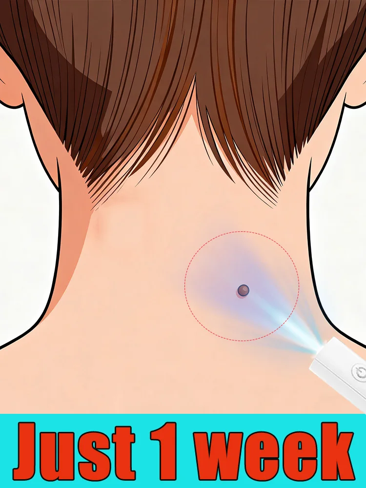 The Latest Generation Blue Light Laser Pen for Wart Removal Has Improved Its Effectiveness By 50%, Quickly Eliminating Warts