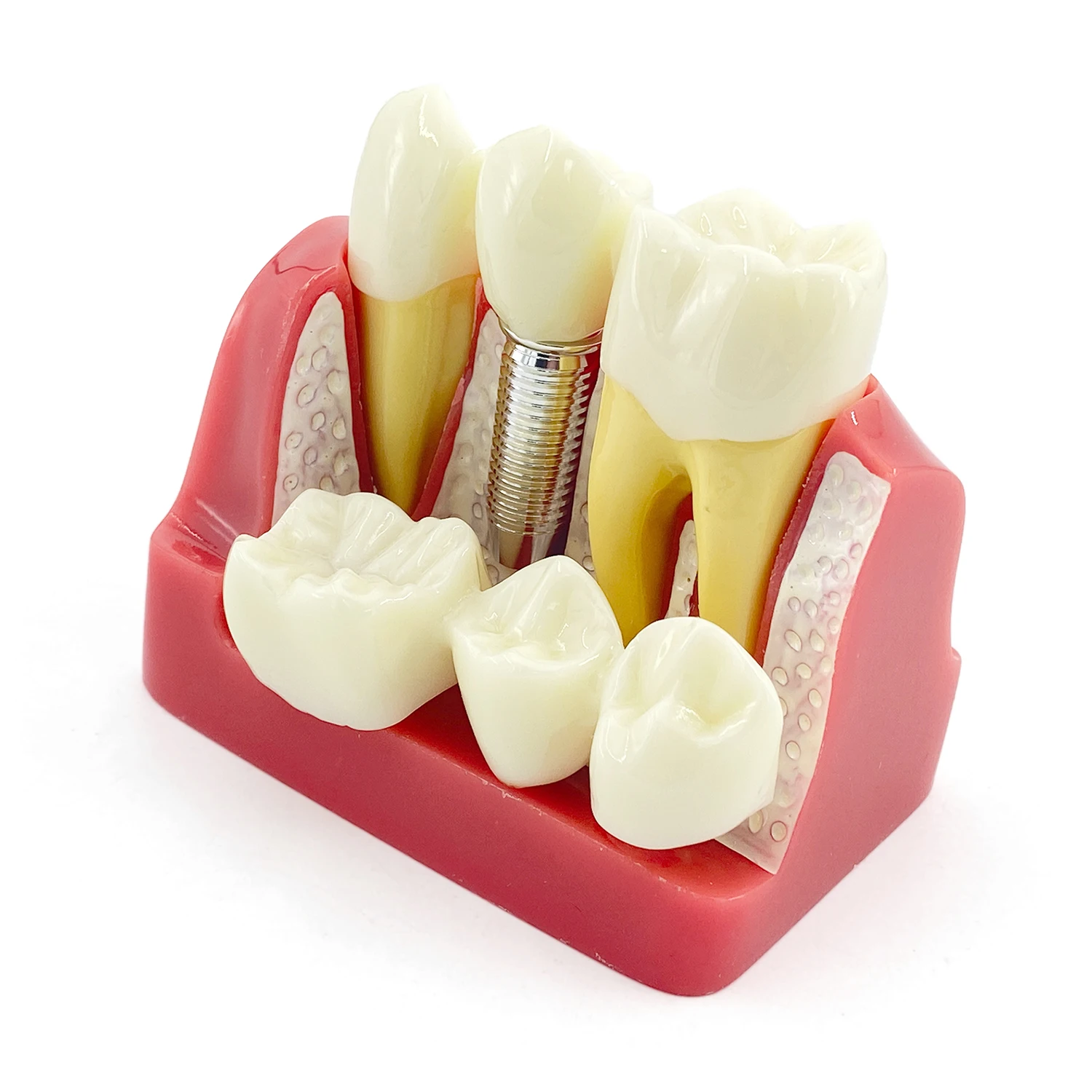 WellCK Dental Teaching Implant Analysis Crown Bridge Removable Model Dental Demonstration Teeth Model