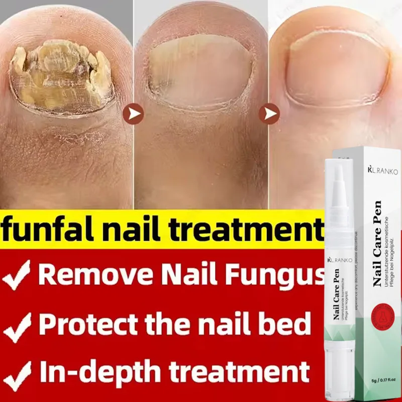 เล็บ Fungal Treatment Serum เท้าเชื้อราเล็บกําจัดน้ํามันหอมระเหย Anti Infection Onychomycosis Paronychia Repairing Care