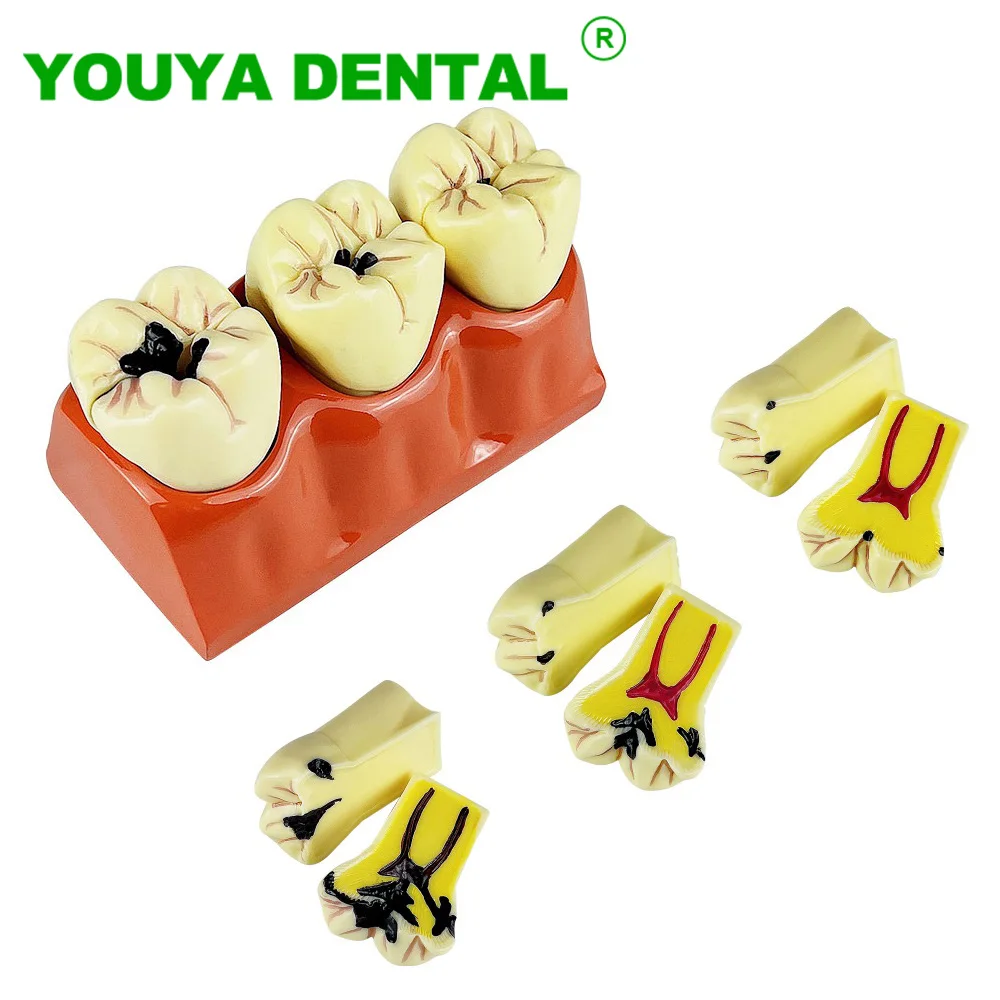 Dental Education Model 4 Times Caries Evolution Model Tooth Decay Comparsion Demonstration Model Dentist Study Teaching Tools