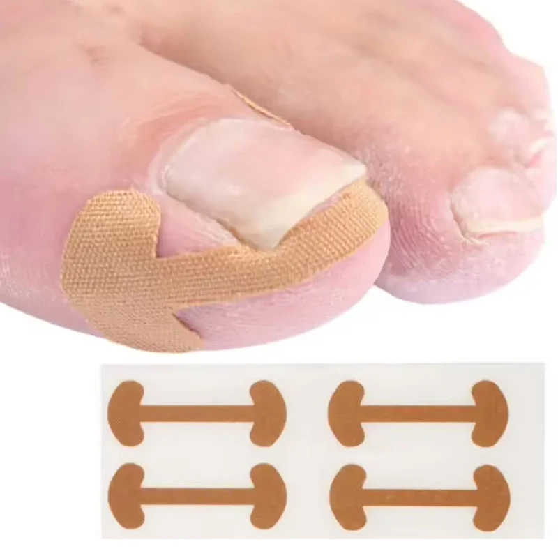 20-100pcs Adhesive Toenail Patch Ingrown Toe Nail Correction Sticker Foot Corrector Pedicure Health Care Tools Toe Treatment Pad - view 5