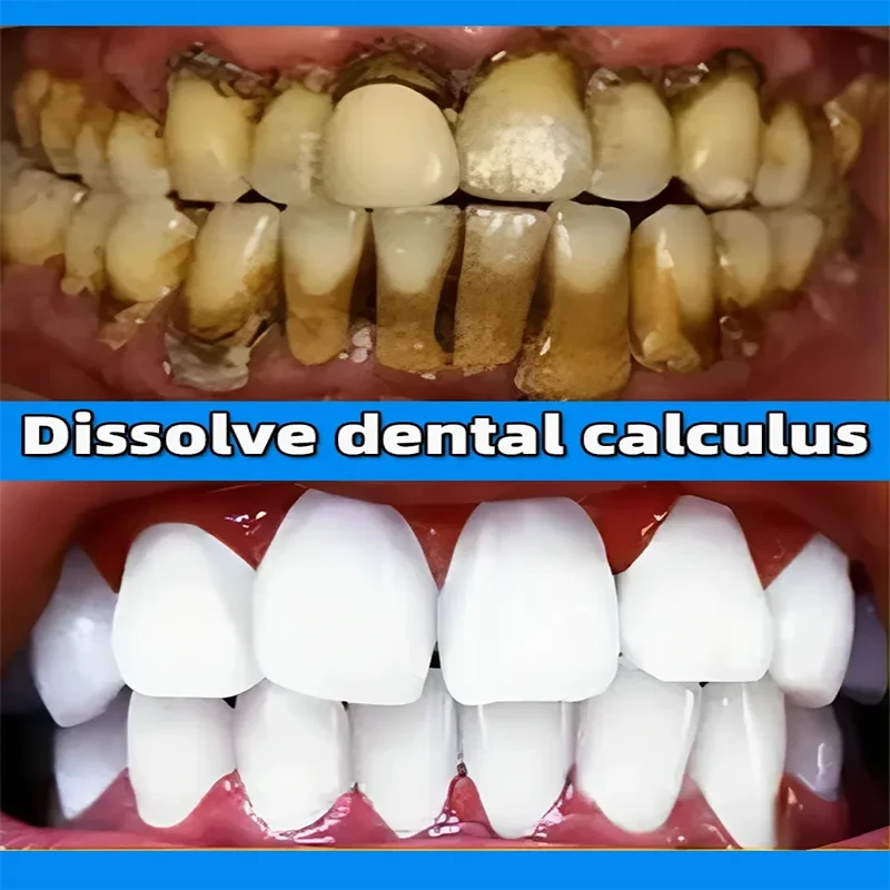 Dissolvant de calcul dentaire anti-mauvaise haleine, blanchiment des dents, dentifrice jaune, éclaircir, prévenir la parodontite, soins de nettoyage dentaire