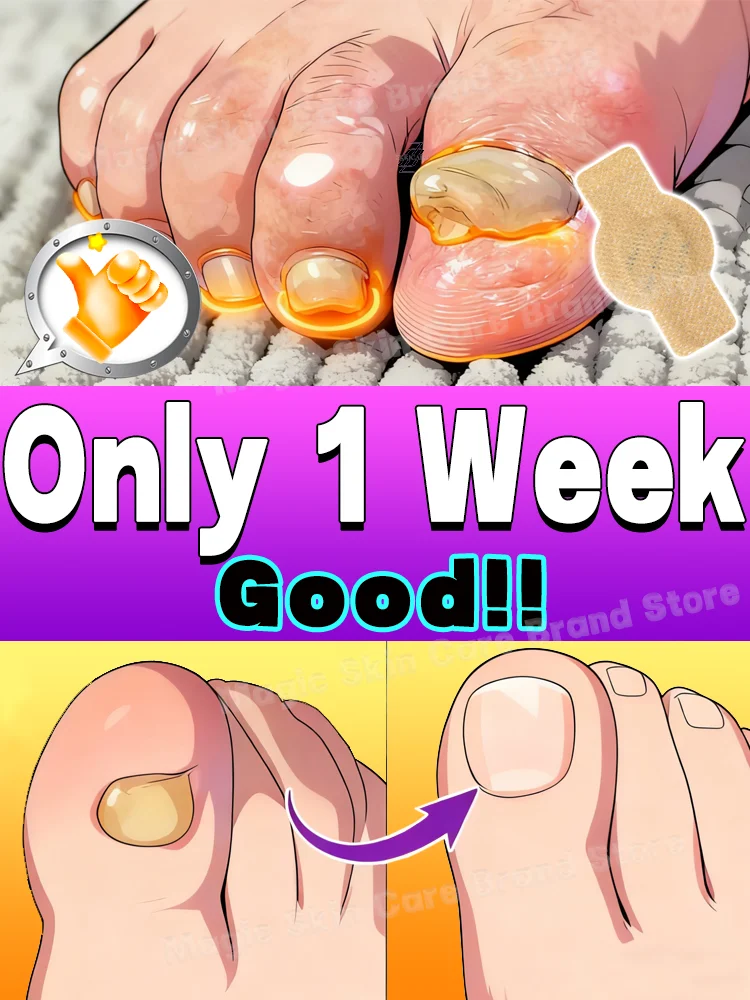 

Simply repair unsightly nails while you sleep – these nail patches have saved my toenails.