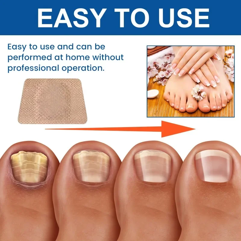 10 Sheet Extra Strength Nail Repair Patches Fast Effective Toenail Damaged Discolored Brittle Nails Renewal Fingernails Sticker