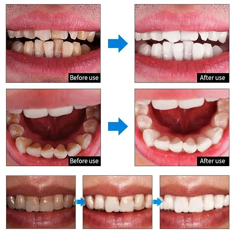 5 Days Teeth Whitening Powder Remove Plaque Stains Dental Calculus Fresh Bad Breath Oral Hygiene Cleaning Tooth Care Products