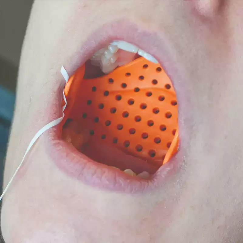 Disposable Dental Oral Anti-Swallow Mesh Prevent Foreign Body Aspiration Safety Barrier Net 50Pcs Per Bag