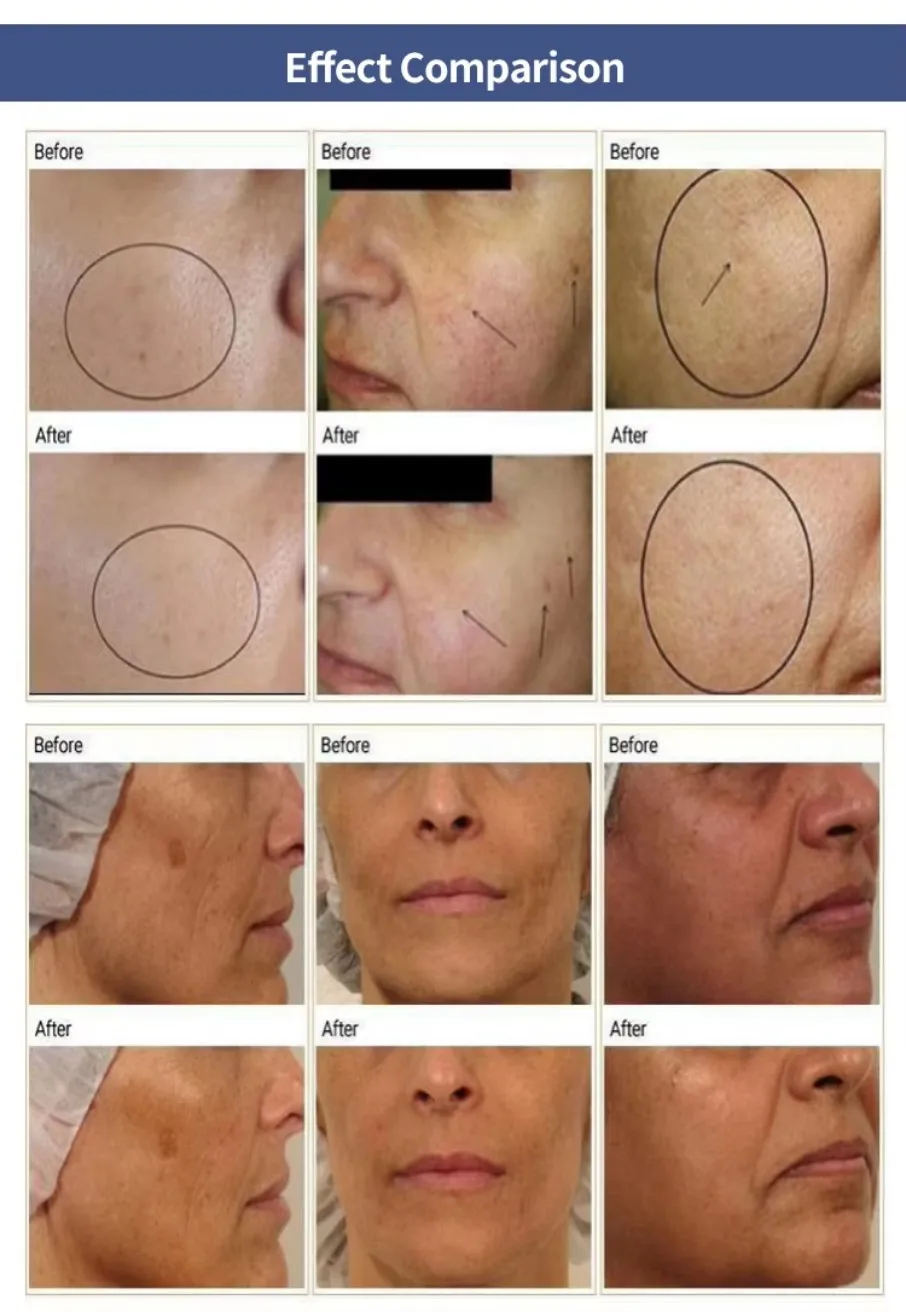 Professionale 3 in 1 Plus Ossigeno viso Detergente Co2 Ossigenazione Rimozione delle rughe Oxgan Macchina per il getto di bellezza del viso