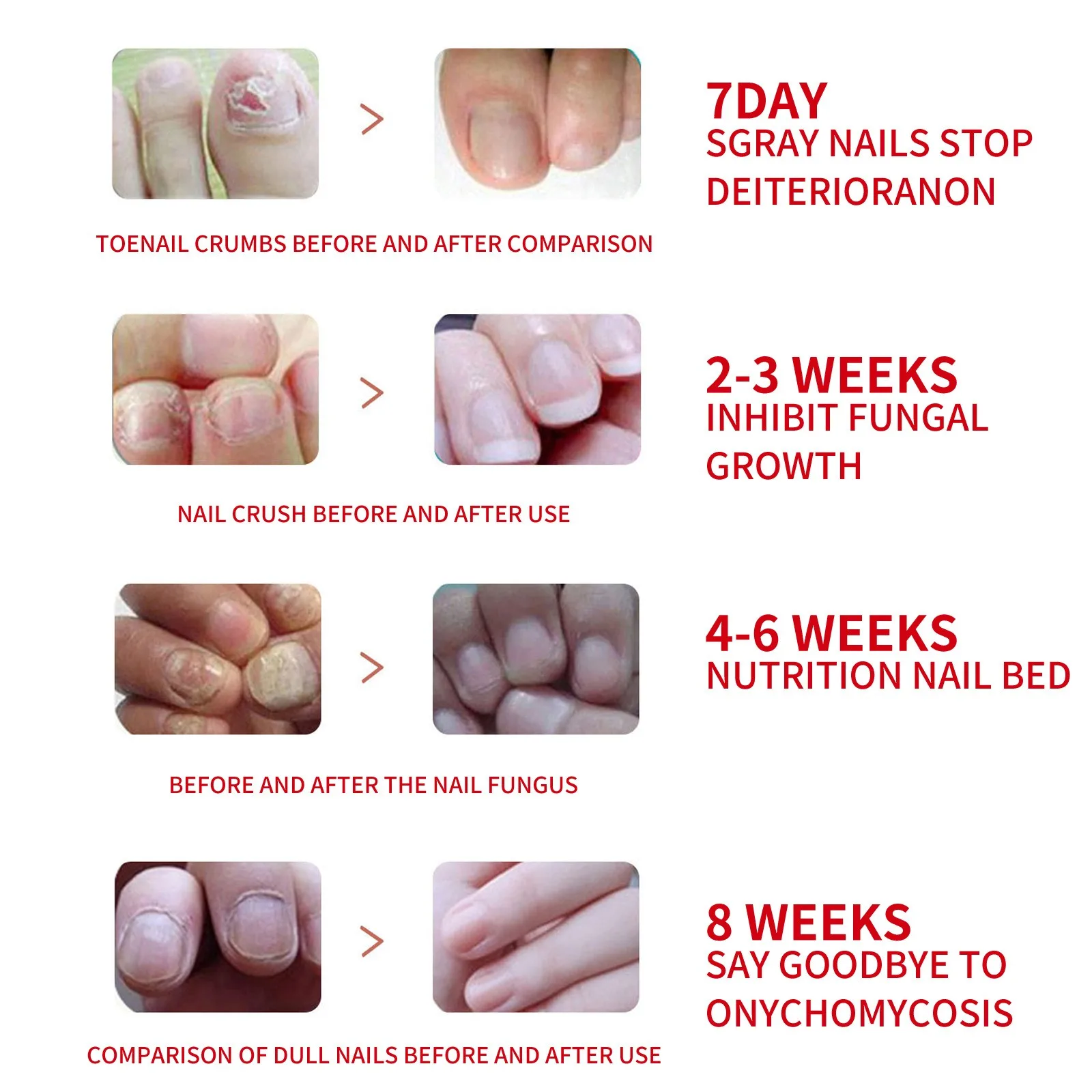 Nagelpflegeflüssigkeit, repariert Vergilbung, graue Fingernägel, Zehennägel, verdickt die Nägel, verhindert Nagelrotten, Nagelpflege-Essenz, 20 ml, sicher