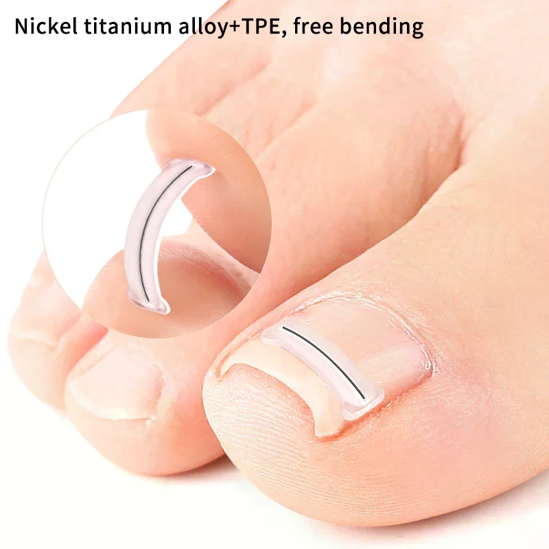 2 Stuks Nagel Correctie Stickers Ingegroeide Teennagel Corrector Patches Paronychia Behandeling Herstellen Corrector Pedicure Gereedschap Voetverzorging