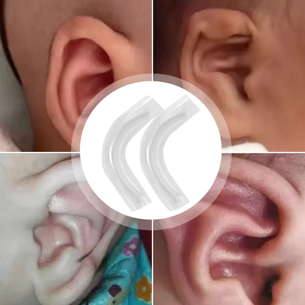 Protruding Ear Support Infant Corrector Tools Silicone Auricle Correction Patch For BabyEar Corrector Baby Auricle Valgus Kit view 6
