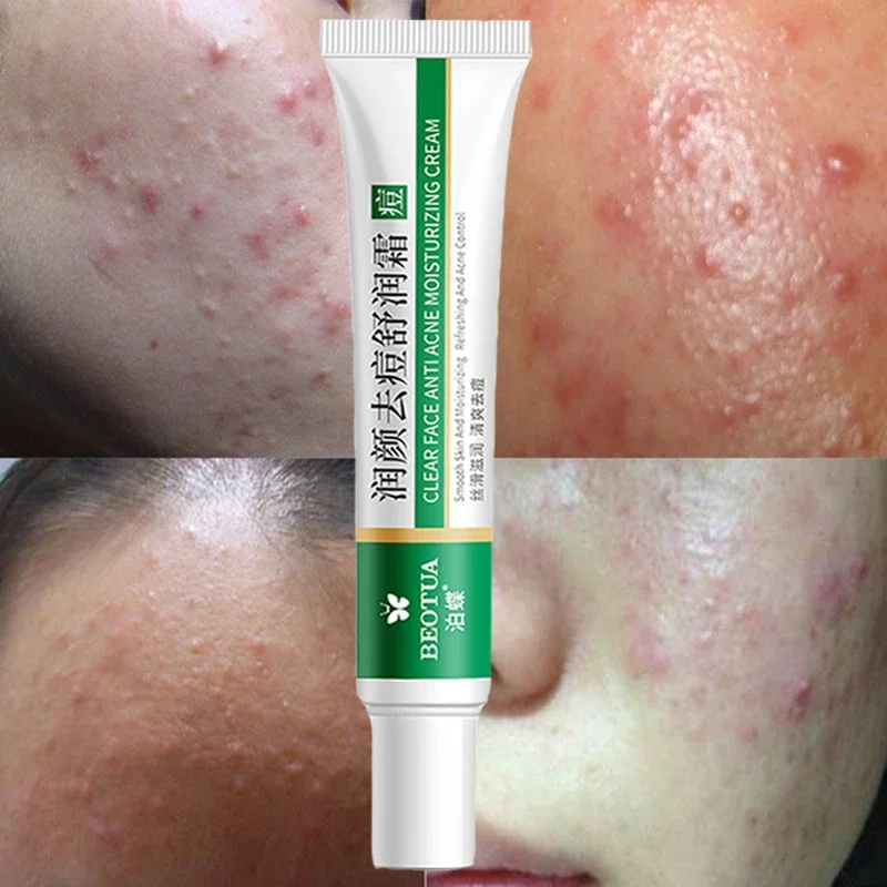 Acne Treatment Cream Face Skin Care Effective Herbal Black Dots Acne Pimple Mark Remover Anti-aging Moisturizin Whitening Cream