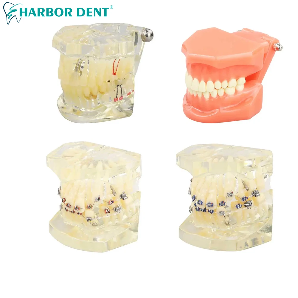 

Dental Orthodontic Treatment Teeth Model Malocclusion Correction With Metal Brackets Teach Models Study for Patient Communicatio