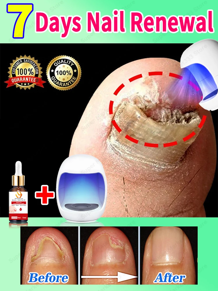 Laser For Solving Feet Nail