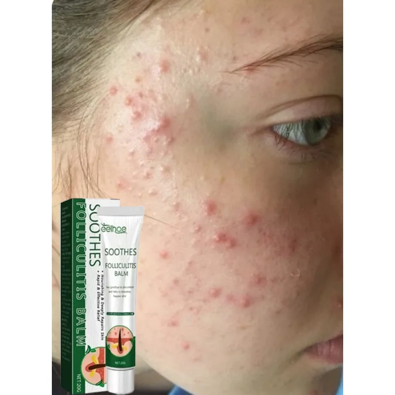 

Anti-Acne Cream Effectively Removes Skin Nodules Pustules Cysts Papules Blackheads Men And Women Acne Skin Care Essence Cream