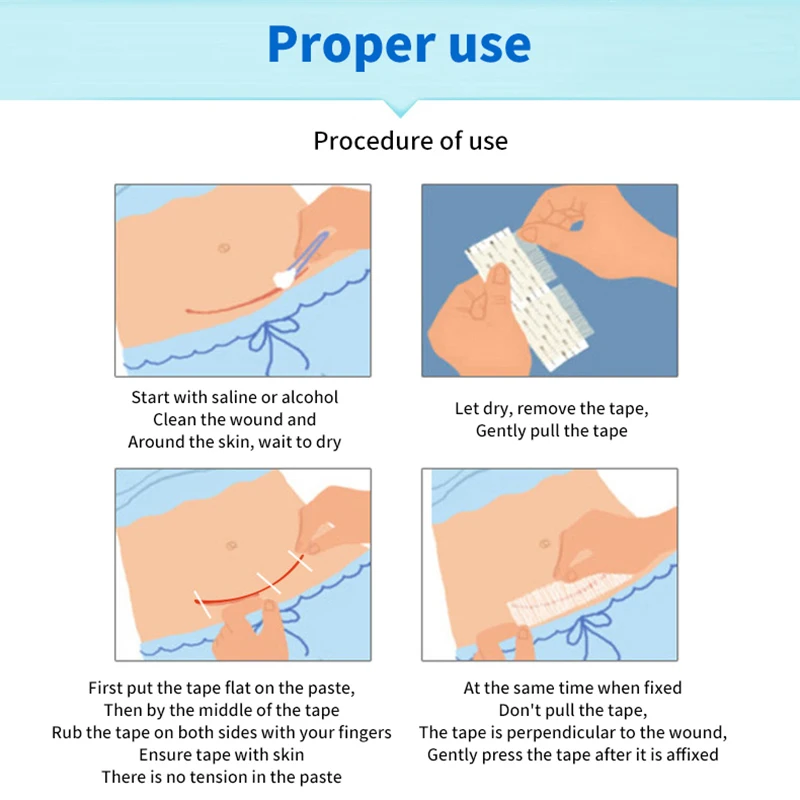 شريط معقم للإسعافات الأولية أثناء السفر وإغلاق الجلد لاصق جراحي طبي
