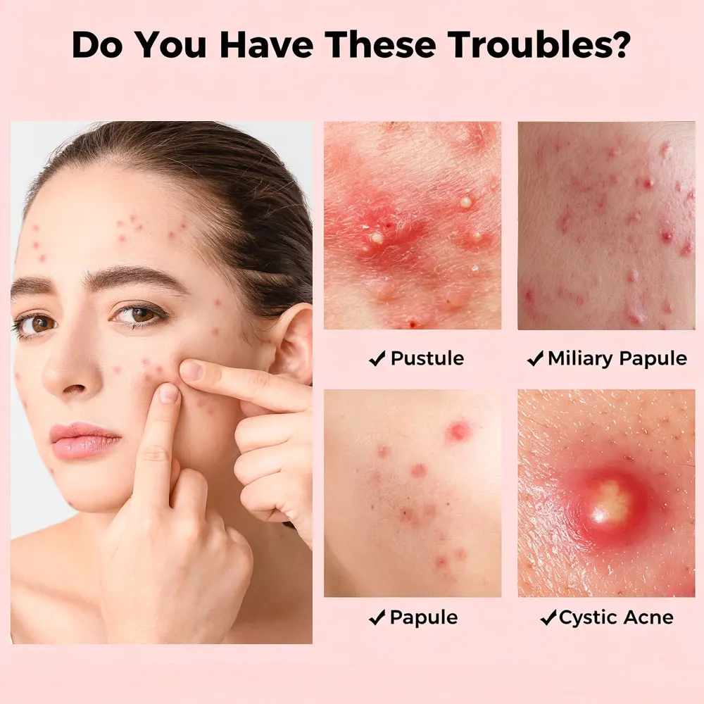 Microneedle Star Pimple Patch9/18pcSalicylic Acid Invisible Acne Cover Stickers Deep Clear Zits Fade Acne Marks Scar Repair Skin