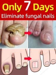 Fungal Nail Repair Fast Onychomycosis Fungus Nails