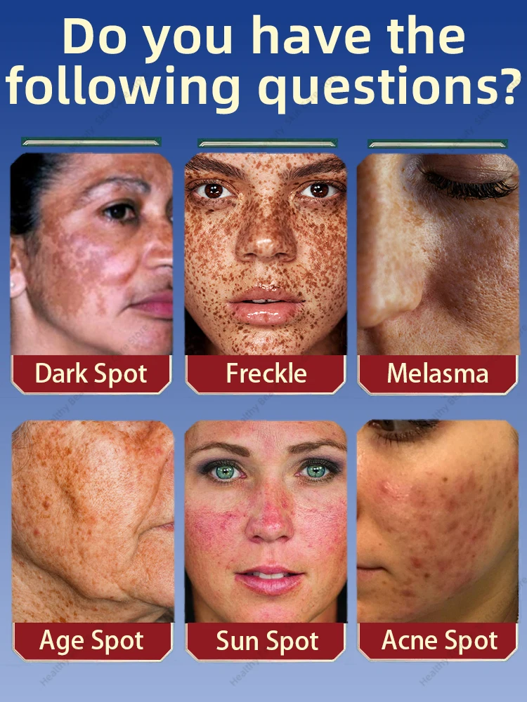 Solve all melasma trouble