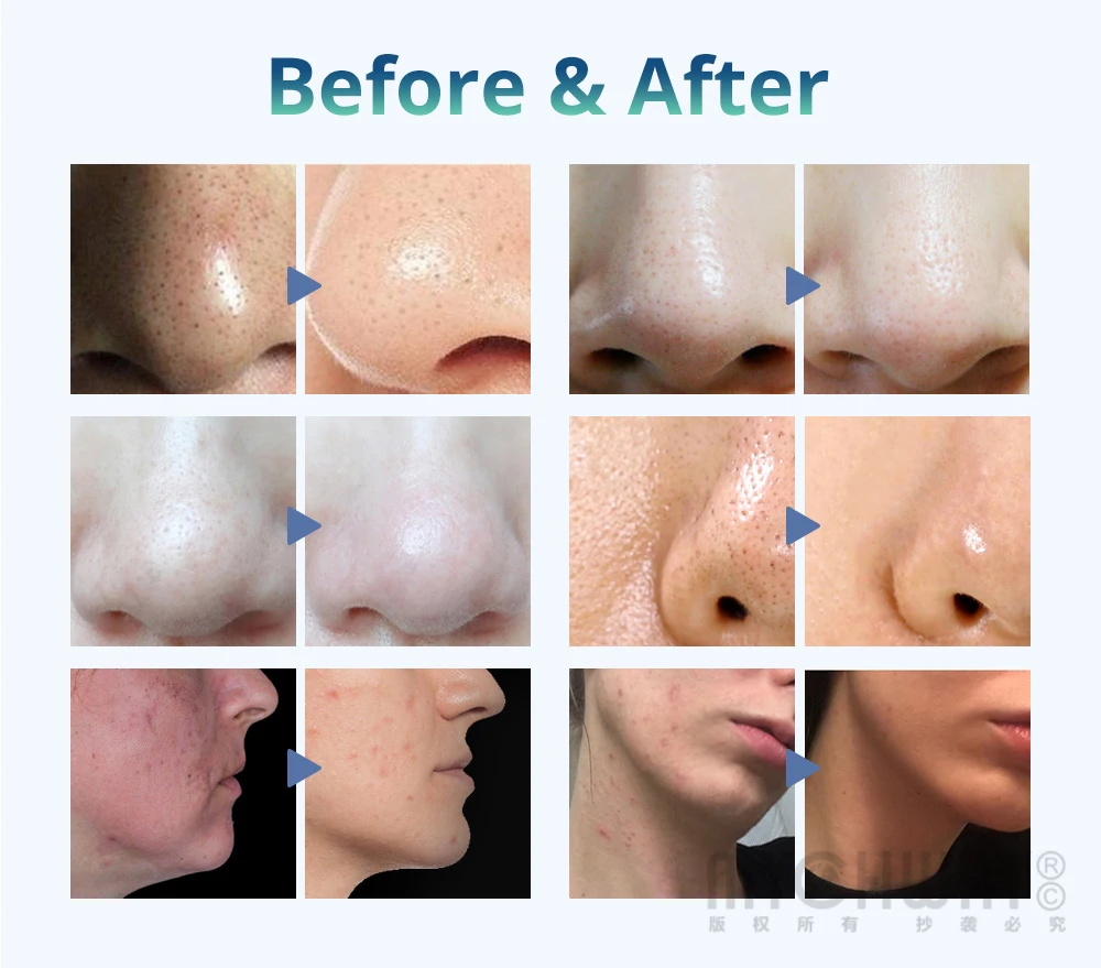 أحدث 6 في 1 آلة تبريد بخاخ الجلد بالموجات فوق الصوتية #4