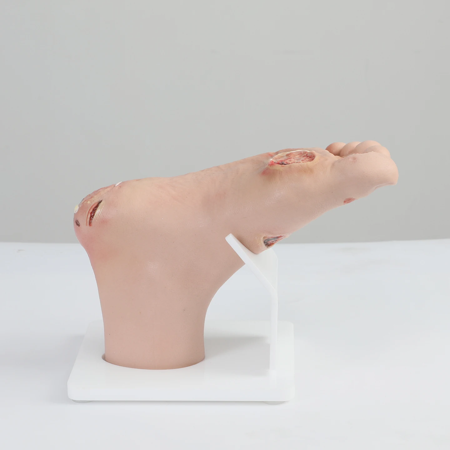 Diabetic Foot Care Model: Foot and Leg Ulcers in Diabetic Patients; Medical Conditions: Ulcerated Feet and Legs