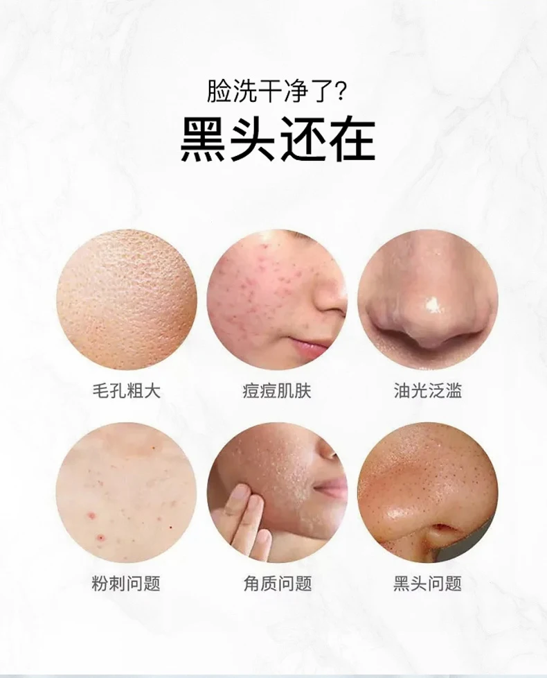 Frete grátis remoção de acne facial cravo cutina limpeza profunda poros importação limpador de pele