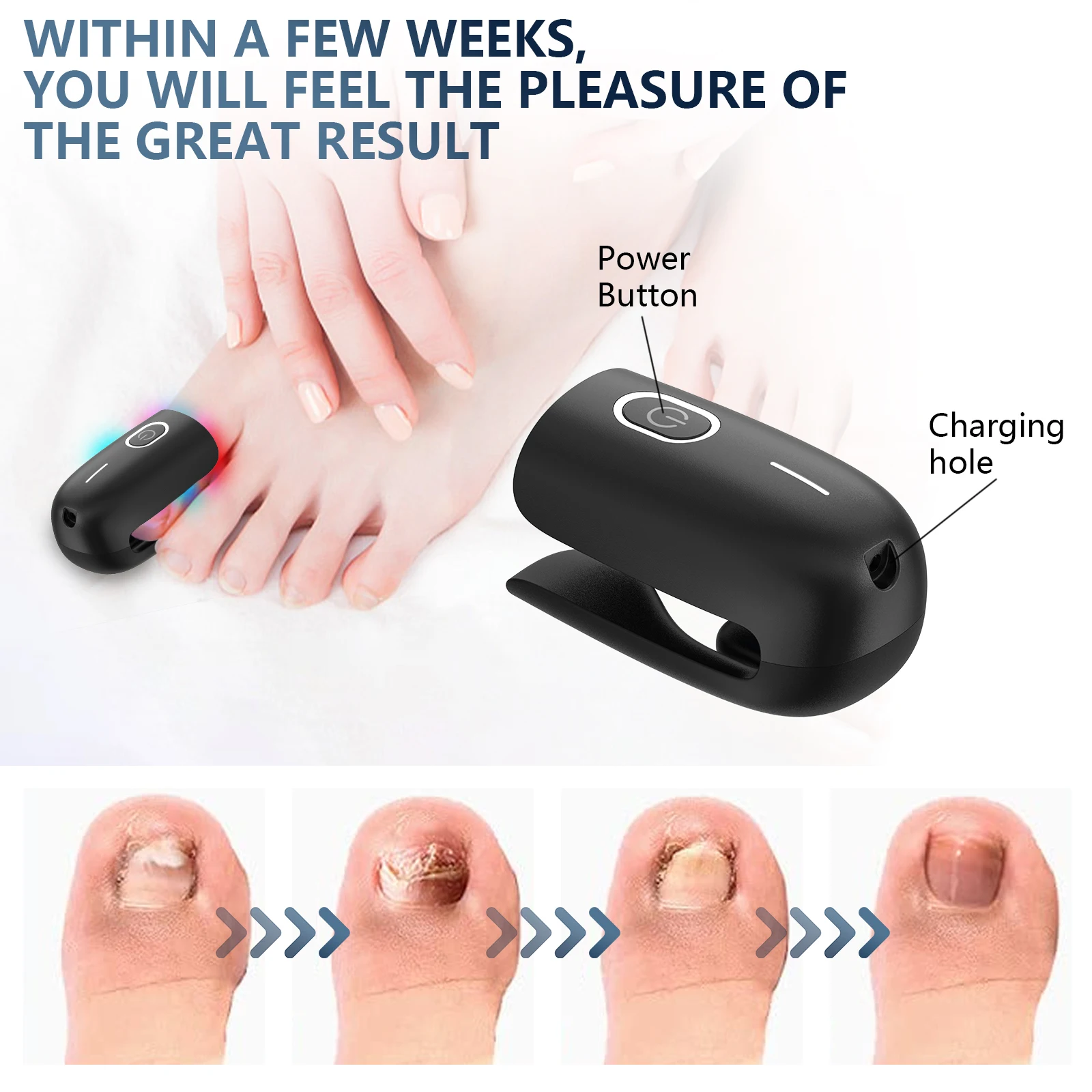 KTS Nail Fungus Laser Device Toenail Laser Therapy Machine Anti Fungal Laser Equipment for Onychomycosis 910nm 407nm USB Charge