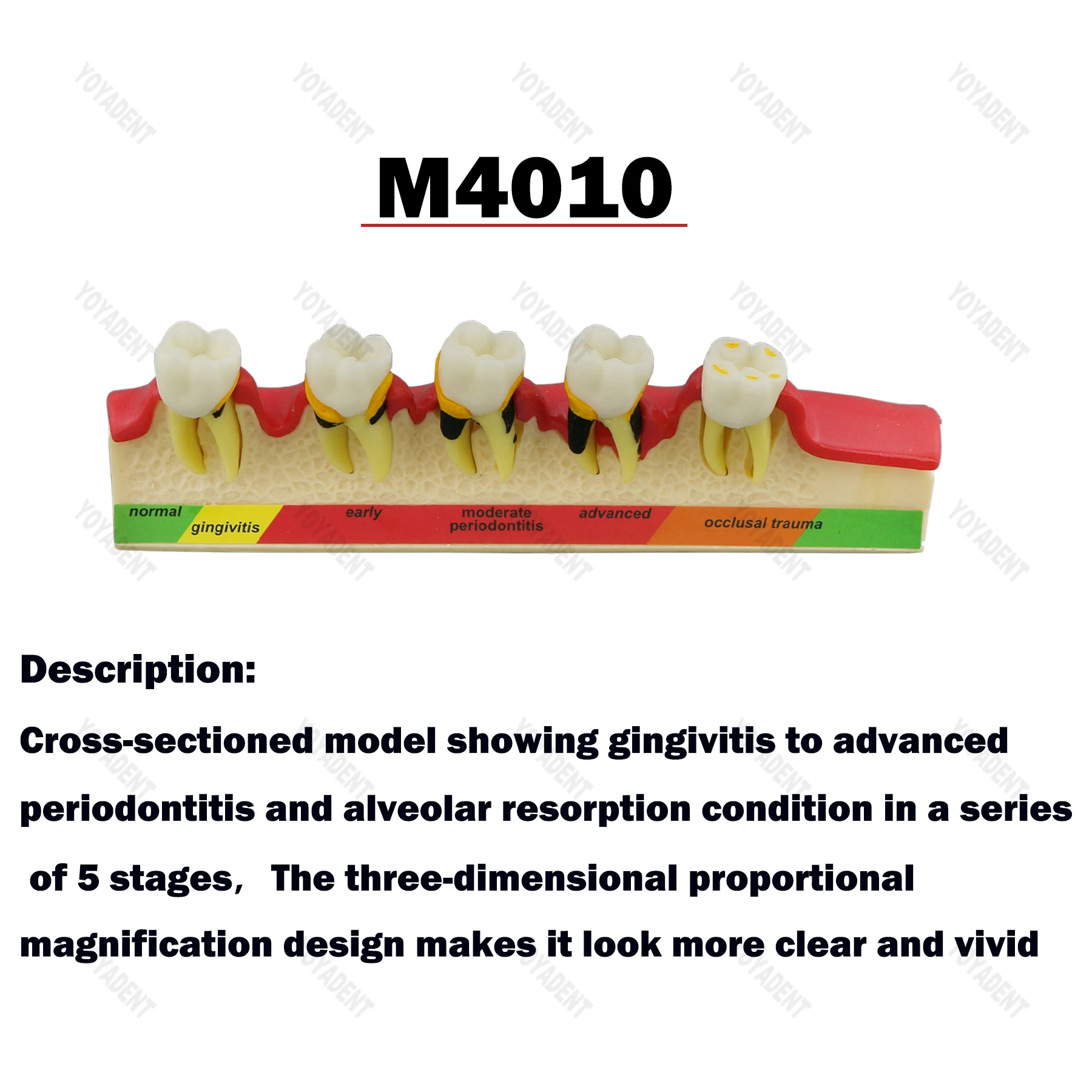 Model Gigi Gigi 4 Tahap Endodontik 5 Tahap Model Pengajaran Penyakit Periodontal untuk Alat Demo Pendidikan Pasien