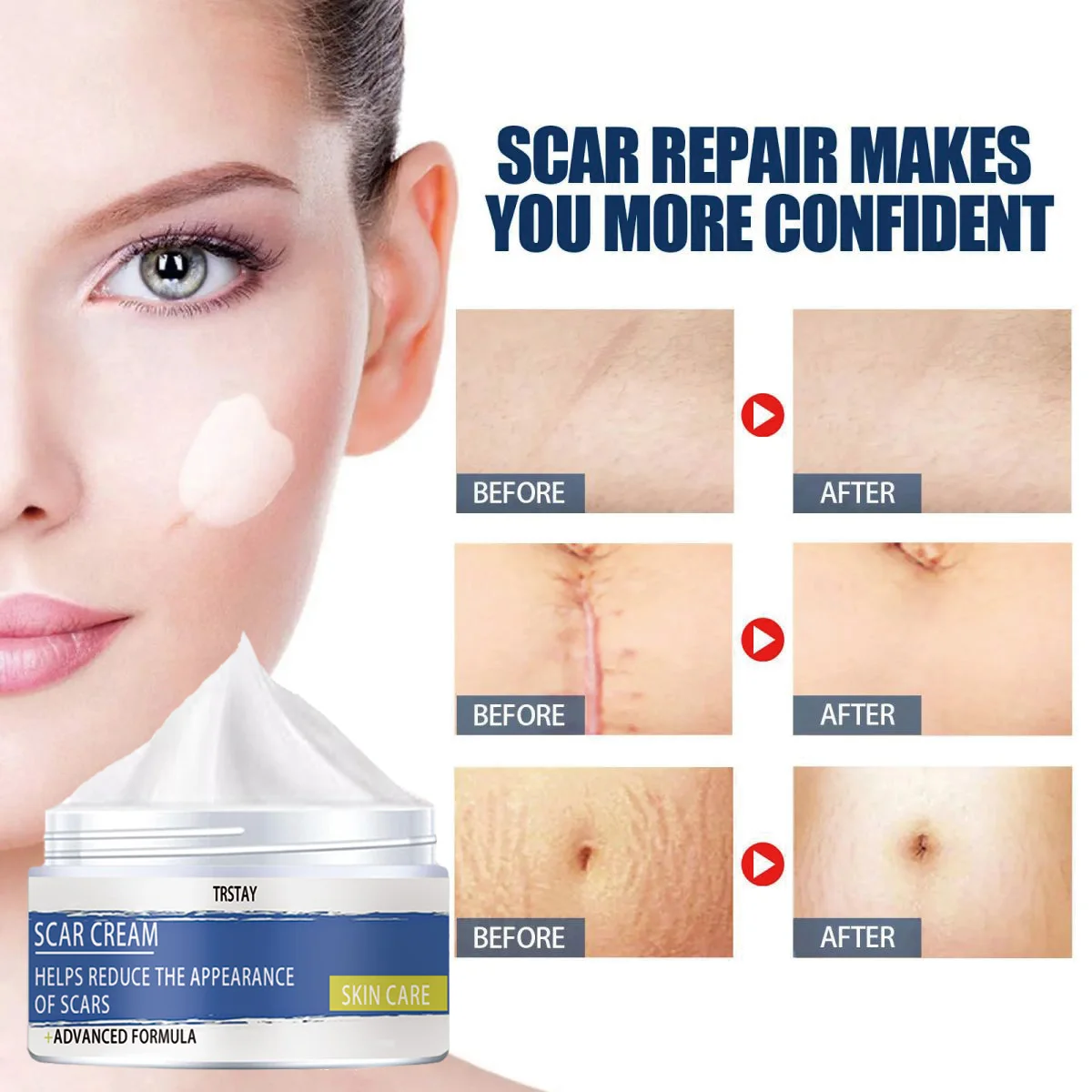 

TRSTAY Scar Repair Cream Melanin Fading Skin Care Striae Gravidarum Care for Mother & Kids Pregnancy & Maternity