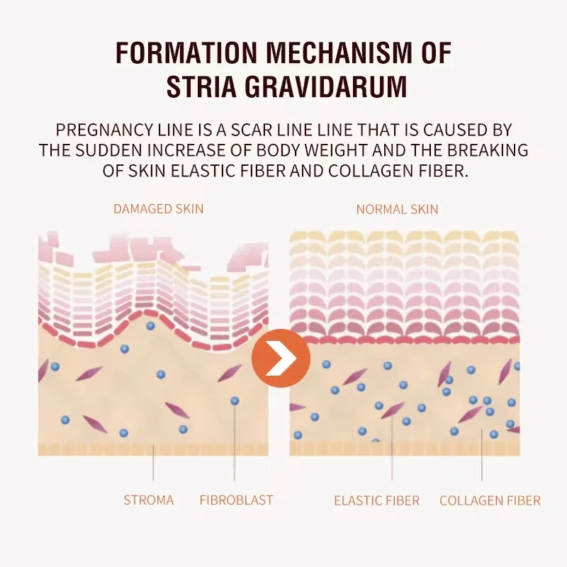 Creme de Remoção Permanente de Estrias, Gestantes Gestantes, Gravidez, Anti-Rugas, Reparação Suave, Pele Reafirmante, Cuidados com a Pele Corporal