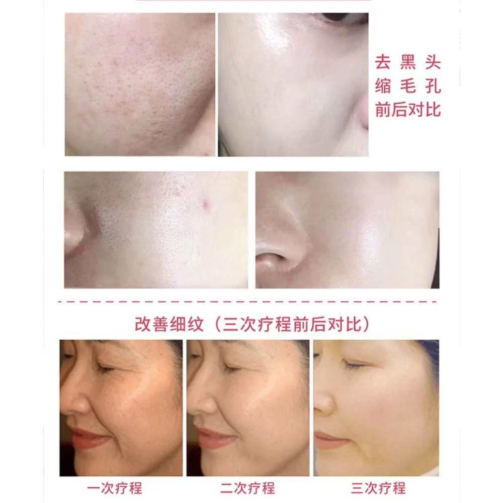 Tender Essence Set Microcrystalline Implantation Serum Collagen Regeneration Skin Rejuvenation Anti-wrinkle Nourishing Skin Care