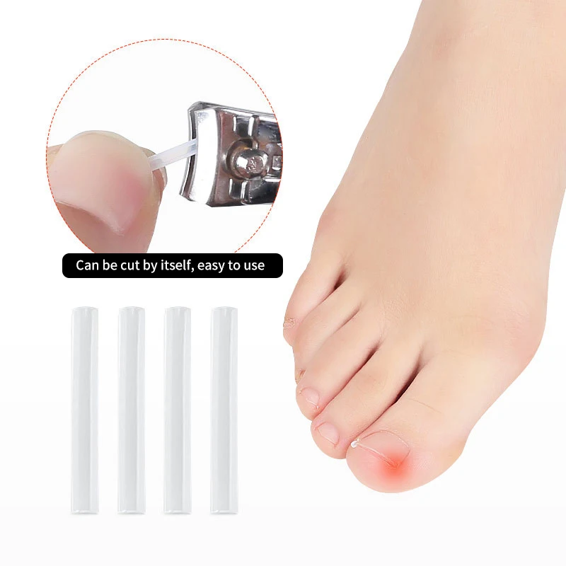 50Pcs Ingrown Toenail Correction Tool Ingrown Toe Nail Treatment Elastic Patch Sticker Straightening Clip Brace Pedicure Tool