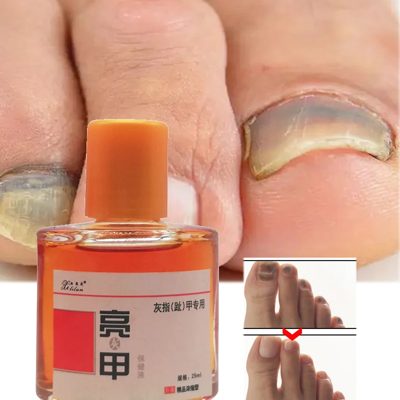 

3/5pcs Toenail Fungus Removal Serum SKU:YG-568x3@#SMT1315yjz