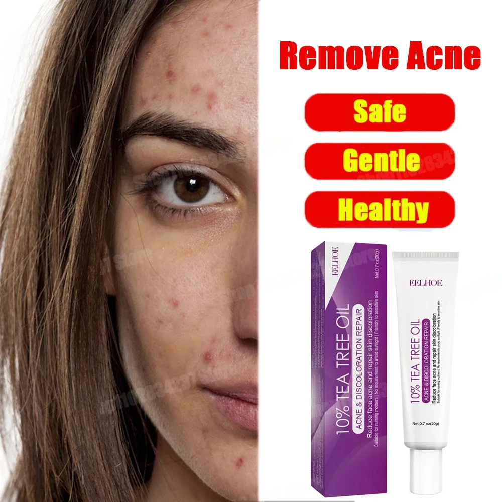 

Tea Tree Acne Treatment Cream Pore Shrink Oil Control Whitening Repair Pimple Deep Cleaning Anti-acne Moisturizer Face Skin Care